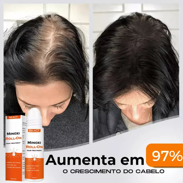 Diminui Queda 95% Aumenta Crescimento 20x | Minoxi Hair® | PAGUE 1 LEVE 2