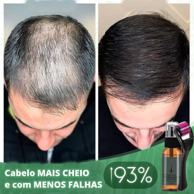 Aumente o Crescimento em 20x | Hair Stimulator® | PAGUE 1 LEVE 2